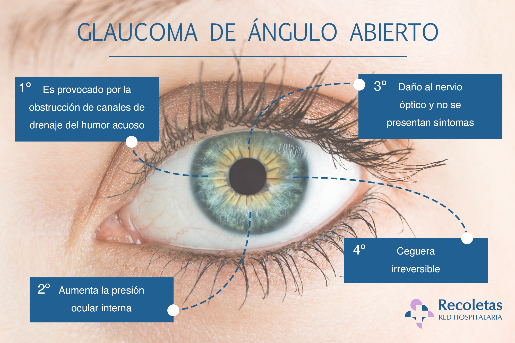 glaucoma3