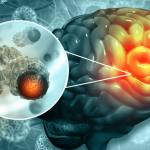 Los tumores cerebrales tienen una característica diferenciadora respecto a los que pueden surgir en otras partes del cuerpo; tienen poco espacio para crecer debido al cráneo. Esta situación hace que su crecimiento pueda comprimir partes vitales del cerebro.