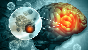 Tumores cerebrales: qué son, diagnóstico y tratamiento