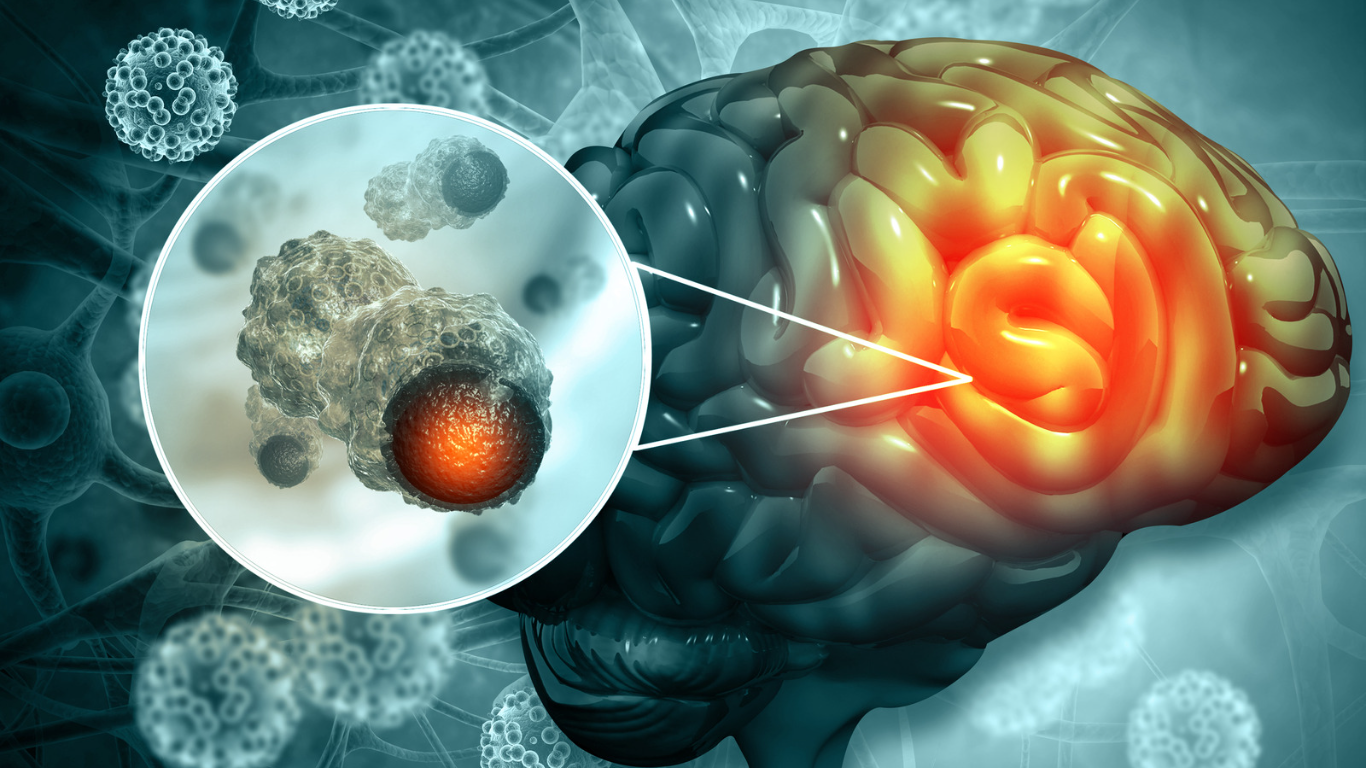 Los tumores cerebrales tienen una característica diferenciadora respecto a los que pueden surgir en otras partes del cuerpo; tienen poco espacio para crecer debido al cráneo. Esta situación hace que su crecimiento pueda comprimir partes vitales del cerebro.