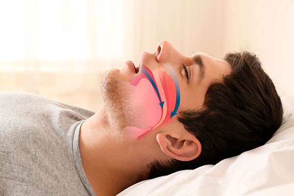 Síndrome de Apnea del sueño