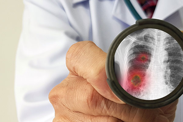 Infecciones bronquiales